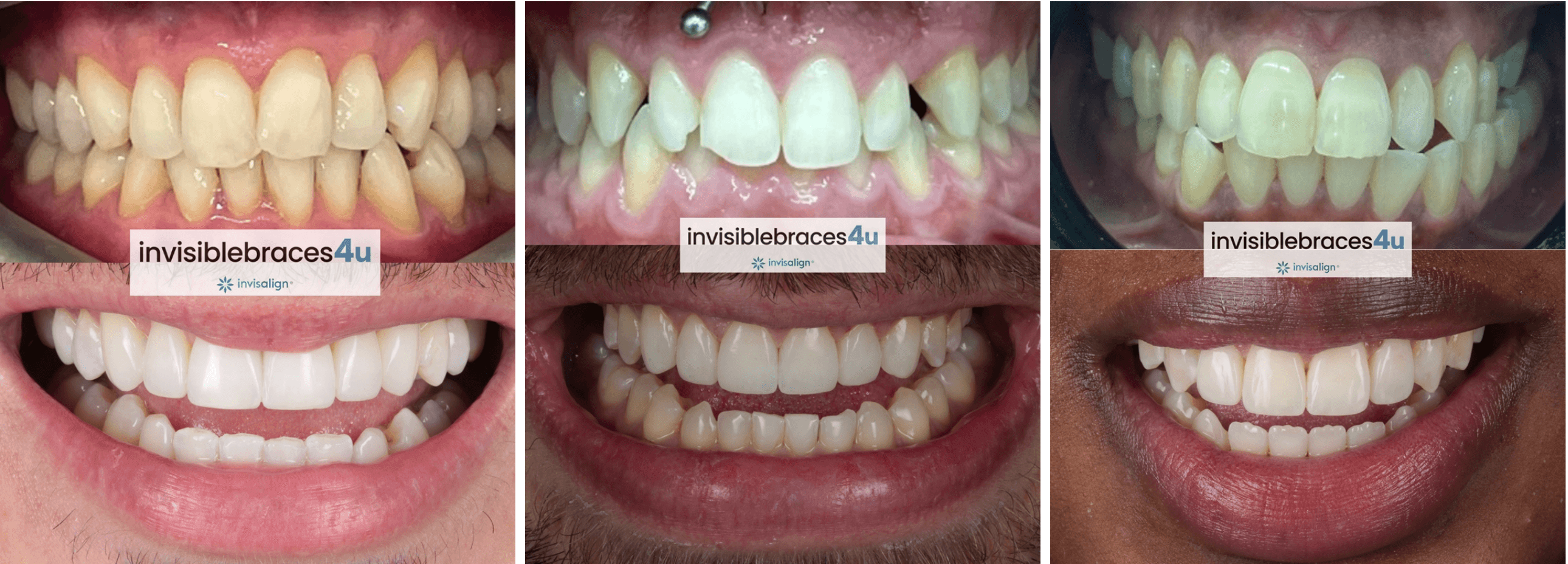 Before and after Invisalign results