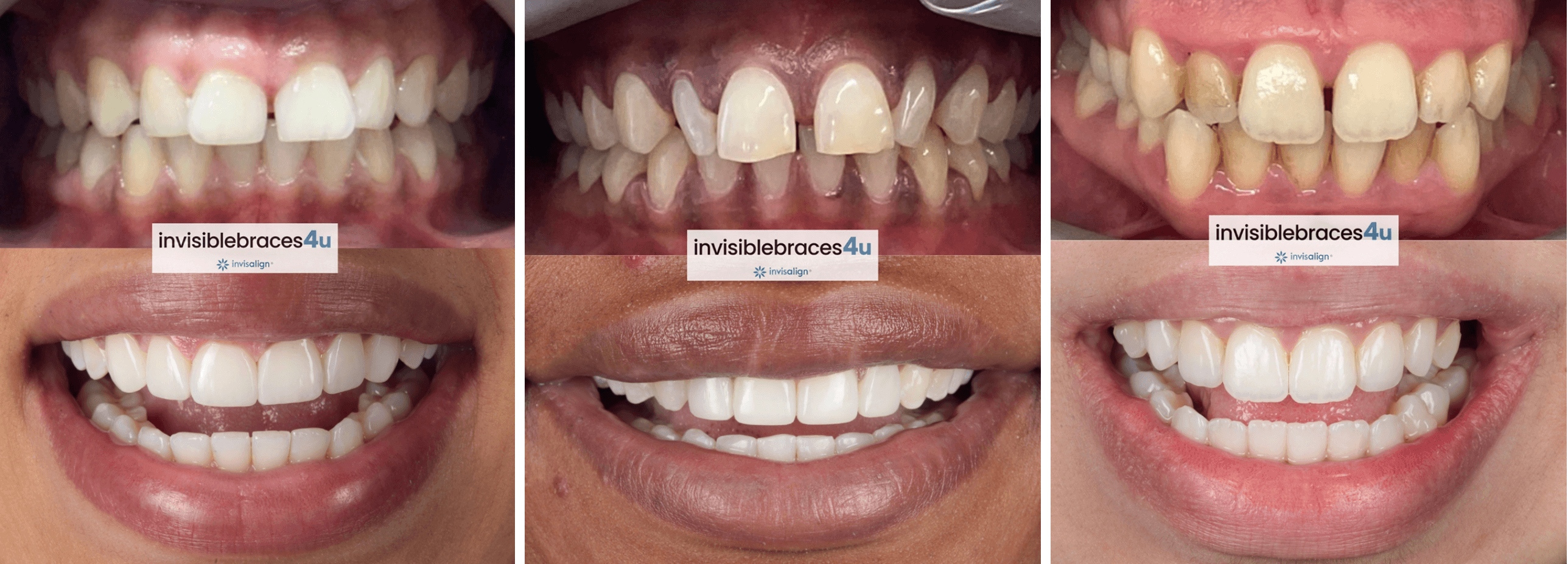Before and after Invisalign results